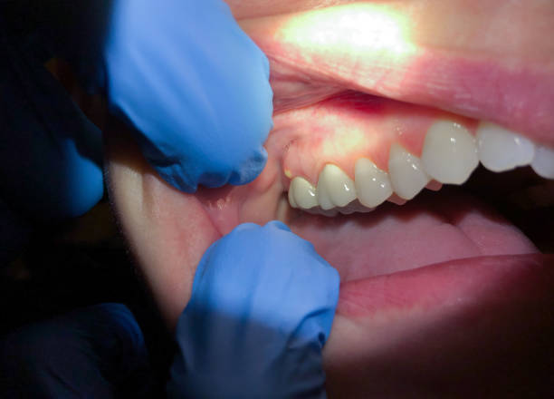 Best Knocked-Out Tooth (Avulsed Tooth) Treatment in Monte Alto, TX